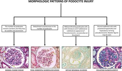 Collapsing Glomerulopathy: A Review by the Collapsing Brazilian Consortium